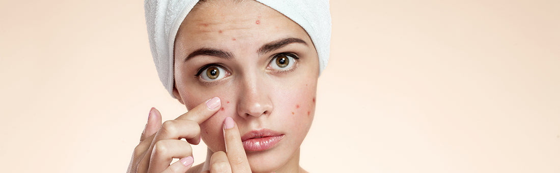 Skin Problem Solutions: Acne